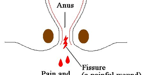 Anal fissure at posterior midline